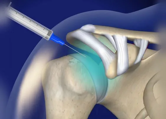 Sacroiliac Joint Injections