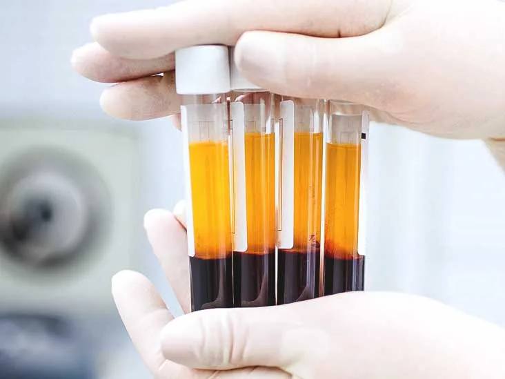 PRP therapy