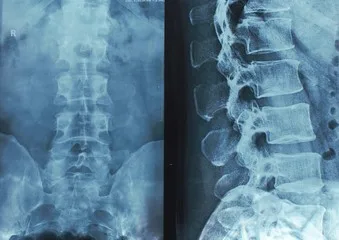 Digital X-Rays