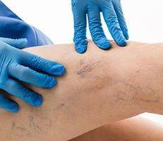 Varicose Veins